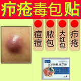 蕴祥火疖子非拔毒膏疖子非拔脓贴疖疮贴毛囊包非拔毒贴硬块坐板穴位贴 1贴*5袋