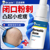 DR.AVIN医用闭口粉刺喷雾脸上起小疙瘩毛孔堵塞可搭祛痘消炎克星药膏GU 2盒【轻度痤疮表现】额头少量小疙瘩适用