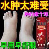 百约王水肿消肿浮肿下肢水肿药消除利脸肿四肢肿老人脚肿全身浮肿去肿湿 买三送二【巩固装】