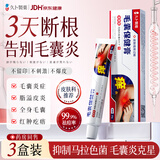 久卜制药毛囊炎药膏止痒专用特效脂溢性皮炎前胸后背头皮脓包马拉色菌3盒