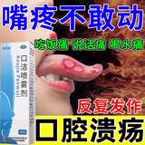 口腔溃疡特药效 上火清火的药 口疮生疮舌头起泡唇角起泡嘴巴溃烂红肿疼痛舌炎口腔溃疡喷剂 口洁喷雾剂 2盒装【上火口舌生疮】