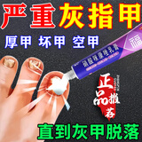 灰指甲根药正治品灰指甲药膏坏指甲真菌感染脱甲去看灰指甲 硝酸咪康唑乳膏【主图视觉特效 成人专用】 1盒本品+盐酸特比萘芬喷雾剂