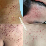 丽人轩【马拉色菌毛囊炎】前胸后背头皮后脑勺长期毛囊堵塞脓包痘痘瘥疮 规格 1盒装【25克】