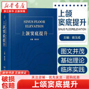 【新华书店】上颌窦底提升