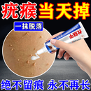 去i疣清宁扁平疣丝状疣瘊子专用去除疣体药膏神器猴子脱落祛疣膏 单盒【限时秒杀】无痛不留痕