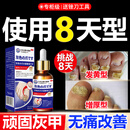 鑫博士灰指甲专门用重度灰指甲真菌感染脱甲坏甲杀菌抑菌液护理霜30ml