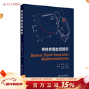 脊柱脊髓血管畸形