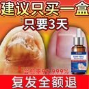 国药药材  重度灰指甲100%特效专用的药特殊效专用抑菌液灰甲净套装 一盒【特效套装】1-2个灰甲选 灰指甲100%特效专用的药第一名