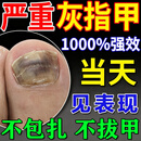 灰指甲专用非药真菌感染指甲增厚发黄变厚亮甲凤仙花灰指甲抑菌液 限时换购秒杀【灰甲液】