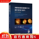 图解玻璃体视网膜手术操作要领与技巧（附手术视频）