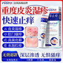 FVSTO湿疹膏止痒抑菌皮肤瘙痒去顽固湿毒皮炎湿疹皮癣真菌感染止痒药膏