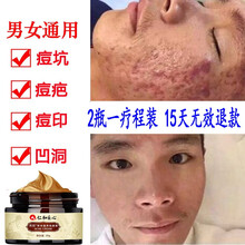 仁和匠心草本祛痘膏祛痘芦荟胶去痘痘痘疤青春痘痘产品男女士学生凹凸修复祛痘霜脸上额头 2盒一疗程(98%患者的选择)