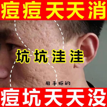 九叶草痘痘膏霜淡化痘印痘坑痘疤修护痘印粉刺控油青春痘男女士