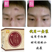 祛疤膏去痘印痣印修复凹凸疤摔伤烫伤增生疤痕 试用一盒装【体现修复装】