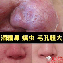 草本一抹灵祛除酒糟鼻修复大红鼻子血丝鼻草莓鼻软膏祛除螨虫粉刺鼻螨虫清毛孔粗大去酒鼻头红肿